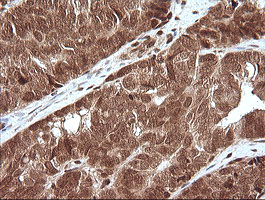 Immunohistochemical staining of paraffin-embedded Adenocarcinoma of Human ovary tissue using anti-MAPK4 mouse monoclonal antibody