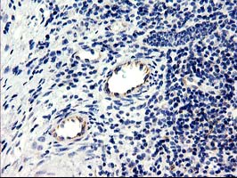 Immunohistochemical staining of paraffin-embedded Carcinoma of Human bladder tissue using anti-CENPH mouse monoclonal antibody