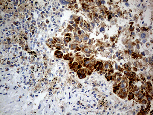 Immunohistochemical staining of paraffin-embedded Carcinoma of Human lung tissue using anti-CHCHD10 mouse monoclonal antibody