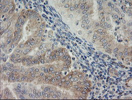 Immunohistochemical staining of paraffin-embedded Adenocarcinoma of Human endometrium tissue using anti-AGTPBP1 mouse monoclonal antibody