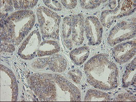 Immunohistochemical staining of paraffin-embedded Carcinoma of Human prostate tissue using anti-AGTPBP1 mouse monoclonal antibody