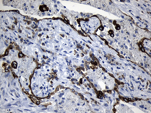 Immunohistochemical staining of paraffin-embedded Carcinoma of Human lung tissue using anti-CISD2 mouse monoclonal antibody