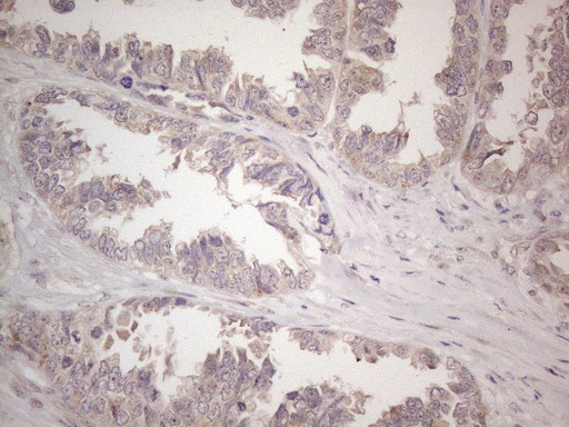 Immunohistochemical staining of paraffin-embedded Adenocarcinoma of Human ovary tissue using anti-CNOT2 mouse monoclonal antibody