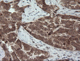 Immunohistochemical staining of paraffin-embedded Adenocarcinoma of Human ovary tissue using anti-CPA2 mouse monoclonal antibody