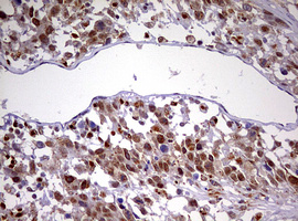 Immunohistochemical staining of paraffin-embedded Adenocarcinoma of Human ovary tissue using anti-CDCA7L mouse monoclonal antibody