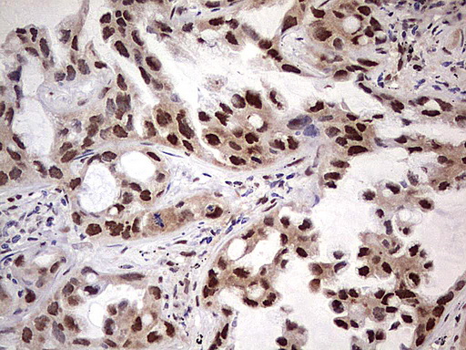 Immunohistochemical staining of paraffin-embedded Carcinoma of Human lung tissue using anti-NAE1 mouse monoclonal antibody