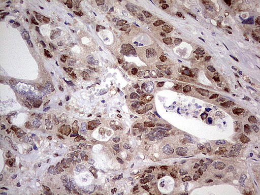 Immunohistochemical staining of paraffin-embedded Adenocarcinoma of Human colon tissue using anti-NAE1 mouse monoclonal antibody