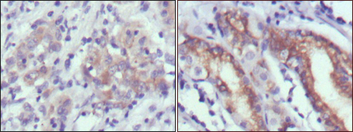 Immunohistochemistry analysis of paraffin-embedded human gastric cancer (left) and normal gastric tissues (right) with DAB staining using Cerberus Monoclonal Antibody