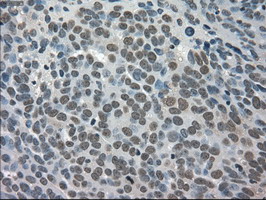 Immunohistochemical staining of paraffin-embedded Adenocarcinoma of Human ovary tissue using anti-TRIB2 mouse monoclonal antibody