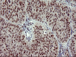 Immunohistochemical staining of paraffin-embedded Adenocarcinoma of Human ovary tissue using anti-RAPGEF1 mouse monoclonal antibody