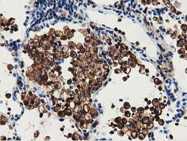 Immunohistochemical staining of paraffin-embedded Carcinoma of Human lung tissue using anti-GAS7 mouse monoclonal antibody at 1:150 (M06548)