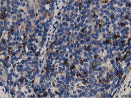 Immunohistochemical staining of paraffin-embedded Adenocarcinoma of Human ovary tissue using anti-GAS7 mouse monoclonal antibody at 1:150 (M06548)