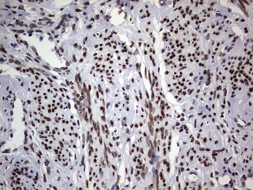 Immunohistochemical staining of paraffin-embedded Human endometrium tissue within the normal limits using anti-TLK2 mouse monoclonal antibody