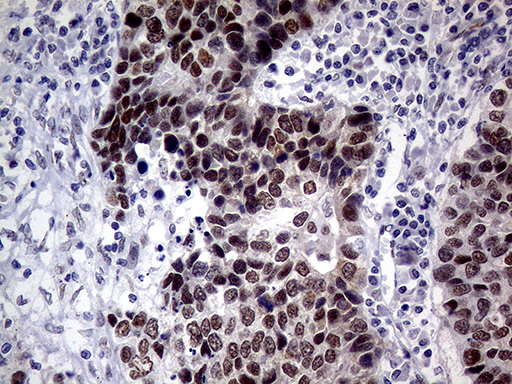 Immunohistochemical staining of paraffin-embedded Carcinoma of Human lung tissue using anti-TLK2 mouse monoclonal antibody