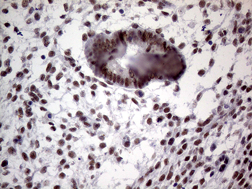 Immunohistochemical staining of paraffin-embedded Human endometrium tissue within the normal limits using anti-TLK2 mouse monoclonal antibody