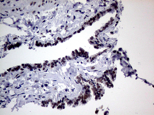 Immunohistochemical staining of paraffin-embedded Human lung tissue within the normal limits using anti-TLK2 mouse monoclonal antibody