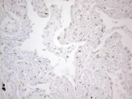 Immunohistochemical staining of paraffin-embedded Carcinoma of Human lung tissue using anti-TLK2 mouse monoclonal antibody