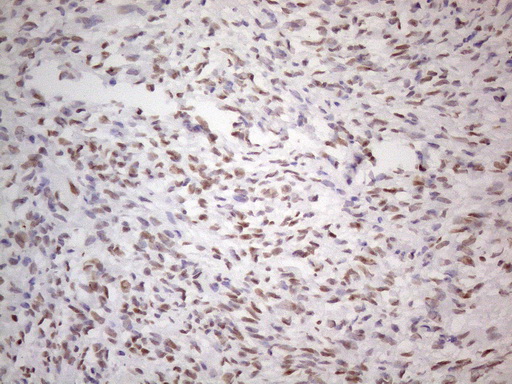 Immunohistochemical staining of paraffin-embedded Adenocarcinoma of Human ovary tissue using anti-TLK2 mouse monoclonal antibody