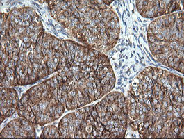 Immunohistochemical staining of paraffin-embedded Adenocarcinoma of Human ovary tissue using anti-VTI1A mouse monoclonal antibody