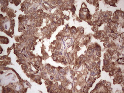 Immunohistochemical staining of paraffin-embedded Adenocarcinoma of Human ovary tissue using anti-SYNM mouse monoclonal antibody