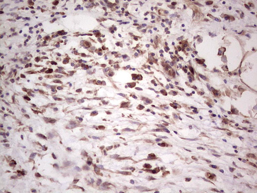 Immunohistochemical staining of paraffin-embedded Carcinoma of Human pancreas tissue using anti-SYNM mouse monoclonal antibody
