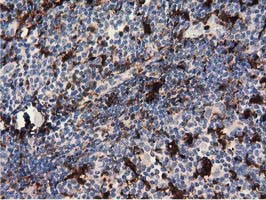 Immunohistochemical staining of paraffin-embedded Human lymphoma tissue using anti-PLEK mouse monoclonal antibody