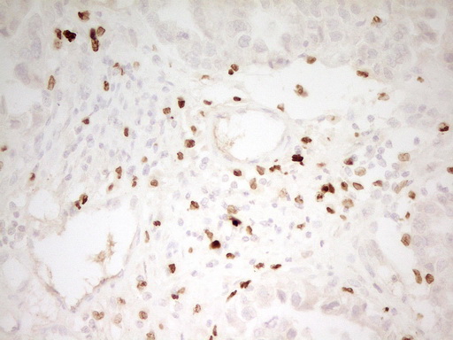 Immunohistochemical staining of paraffin-embedded Adenocarcinoma of Human ovary tissue using anti-MNDA mouse monoclonal antibody