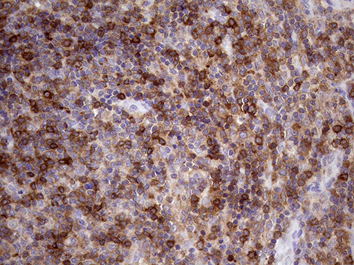 Immunohistochemical staining of paraffin-embedded Human lymphoma tissue using anti-DGKZ mouse monoclonal antibody