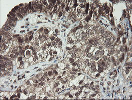 Immunohistochemical staining of paraffin-embedded Adenocarcinoma of Human ovary tissue using anti-LEPRE1 mouse monoclonal antibody