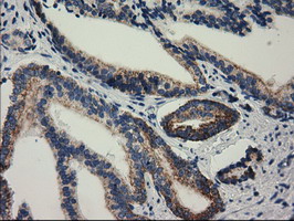 Immunohistochemical staining of paraffin-embedded Carcinoma of Human prostate tissue using anti-RASD2 mouse monoclonal antibody
