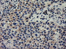 Immunohistochemical staining of paraffin-embedded Carcinoma of Human bladder tissue using anti-RASD2 mouse monoclonal antibody