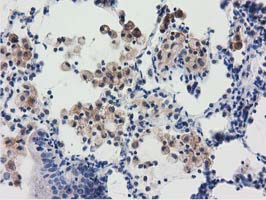 Immunohistochemical staining of paraffin-embedded Carcinoma of Human lung tissue using anti-RASD2 mouse monoclonal antibody