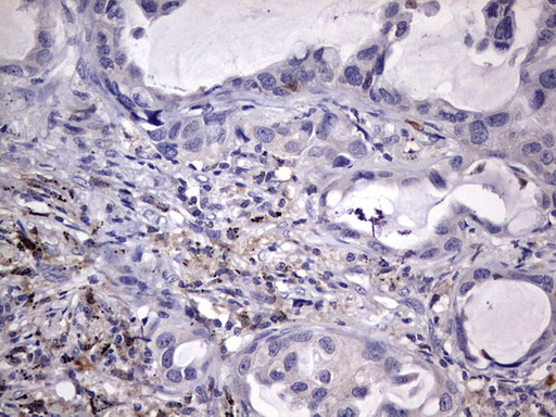 Immunohistochemical staining of paraffin-embedded Carcinoma of Human lung tissue using anti-KYNU mouse monoclonal antibody