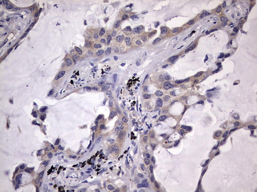 Immunohistochemical staining of paraffin-embedded Carcinoma of Human lung tissue using anti-KYNU mouse monoclonal antibody