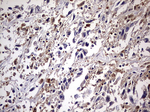 Immunohistochemical staining of paraffin-embedded Adenocarcinoma of Human ovary tissue using anti-KYNU mouse monoclonal antibody