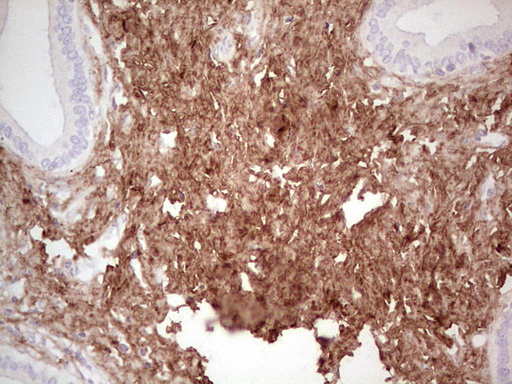 Immunohistochemical staining of paraffin-embedded Carcinoma of Human pancreas tissue using anti-CSNK1G1 mouse monoclonal antibody