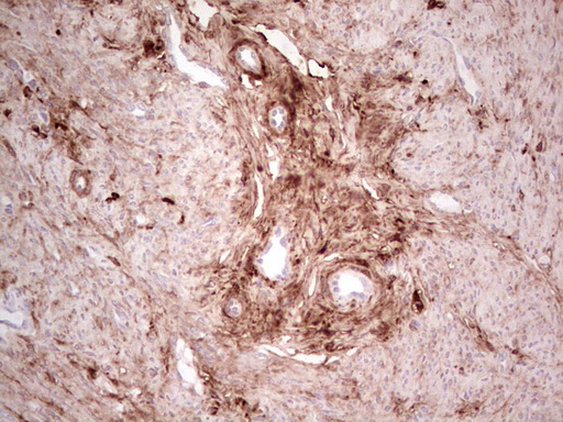 Immunohistochemical staining of paraffin-embedded Adenocarcinoma of Human endometrium tissue using anti-CSNK1G1 mouse monoclonal antibody