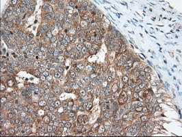 Immunohistochemical staining of paraffin-embedded Adenocarcinoma of Human ovary tissue using anti-MIOX mouse monoclonal antibody