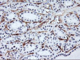 Immunohistochemical staining of paraffin-embedded Carcinoma of Human thyroid tissue using anti-ENPEP mouse monoclonal antibody