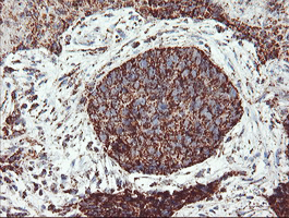 Immunohistochemical staining of paraffin-embedded Carcinoma of Human lung tissue using anti-UQCRC1 mouse monoclonal antibody