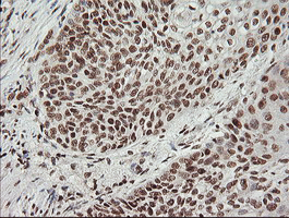 m06981 anti malignant t cell amplified sequence 1 mcts1 mouse monoclonal antibody clone id oti2f9 ihc testing 4