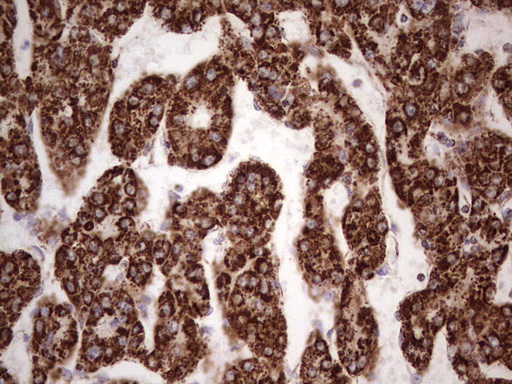 Immunohistochemical staining of paraffin-embedded Carcinoma of Human liver tissue using anti-CANT1 mouse monoclonal antibody