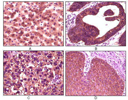 Immunohistochemistry analysis of paraffin-embedded human liver tissue (A), colon carcinoma (B), lung carcinoma (C) and esophagus tissue (D), showing membrane localization with DAB staining using Casein Kinase Iα Monoclonal Antibody