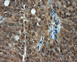 Immunohistochemical staining of paraffin-embedded Adenocarcinoma of ovary tissue using anti-PSMC3 mouse monoclonal antibody
