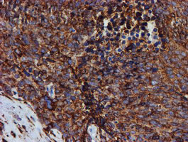 Immunohistochemical staining of paraffin-embedded Adenocarcinoma of Human breast tissue using anti-PDIA4 mouse monoclonal antibody