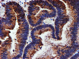 Immunohistochemical staining of paraffin-embedded Adenocarcinoma of Human colon tissue using anti-PDIA4 mouse monoclonal antibody