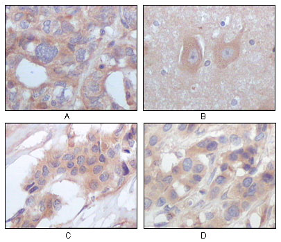 Immunohistochemistry analysis of paraffin-embedded human ovary carcinoma (A), normal cerebrum tissues (B), breast infiltrating carcinoma (C) and breast infiltrating carcinoma (D), showing cytoplasmic localization with DAB staining using NOK Monoclonal Ant