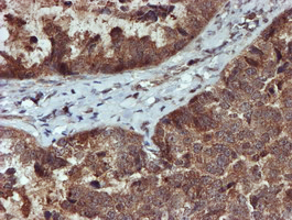 Immunohistochemical staining of paraffin-embedded Adenocarcinoma of Human ovary tissue using anti-C17orf37 mouse monoclonal antibody