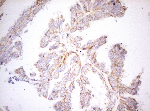 Immunohistochemical staining of paraffin-embedded Adenocarcinoma of Human ovary tissue using anti-DECR1 mouse monoclonal antibody