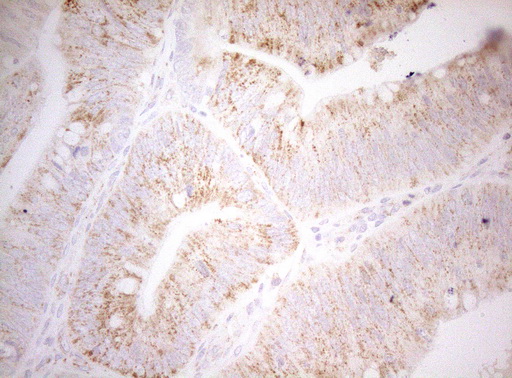 Immunohistochemical staining of paraffin-embedded Carcinoma of Human pancreas tissue using anti-DECR1 mouse monoclonal antibody